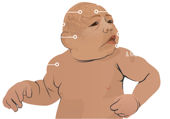 seizures, small head size, coordination difficulties, dwarfism/short stature, backward-sloping forehead, hyperactivity, facial distortions, delays in speech and movement